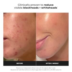 Paula's Choice 2% BHA liquid exfoliant bottle with dropper