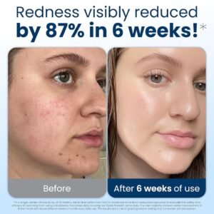 Clinical results after 6 weeks with Clean Towels XL — improved skin barrier and reduced irritation Before and after using Clean Skin Club Clean Towels XL for six weeks — visible reduction in redness and clearer skin